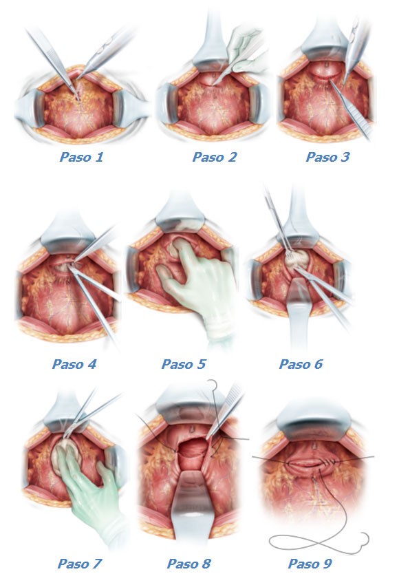 prostatectomía radical abierta técnica quirúrgica prostatita cu streptococ hemolitic